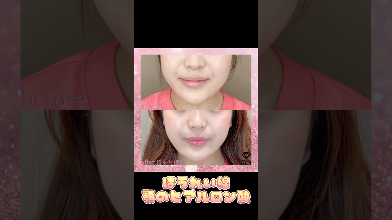 【プチ整形で垢抜け】#shorts #ほうれい線ヒアルロン酸 #顎ヒアルロン #TCBメッシュ