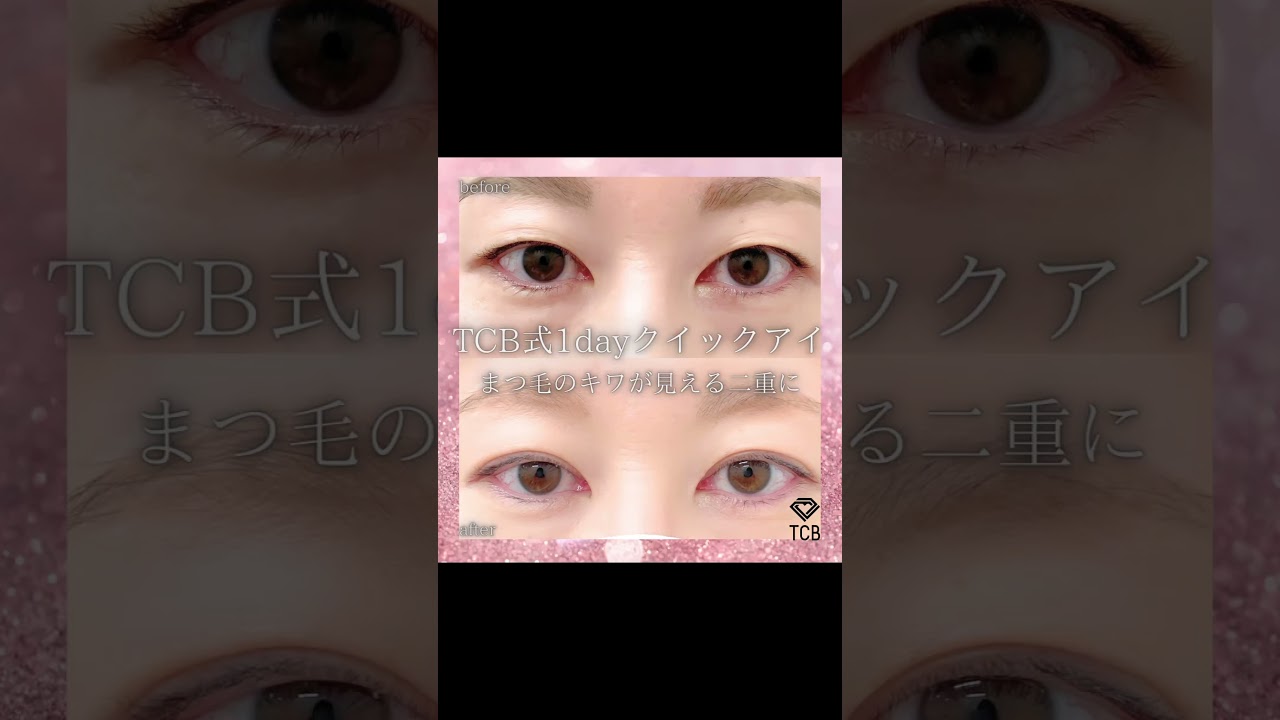 埋没で作る奥二重#shorts#tcb #プチ整形 #二重埋没