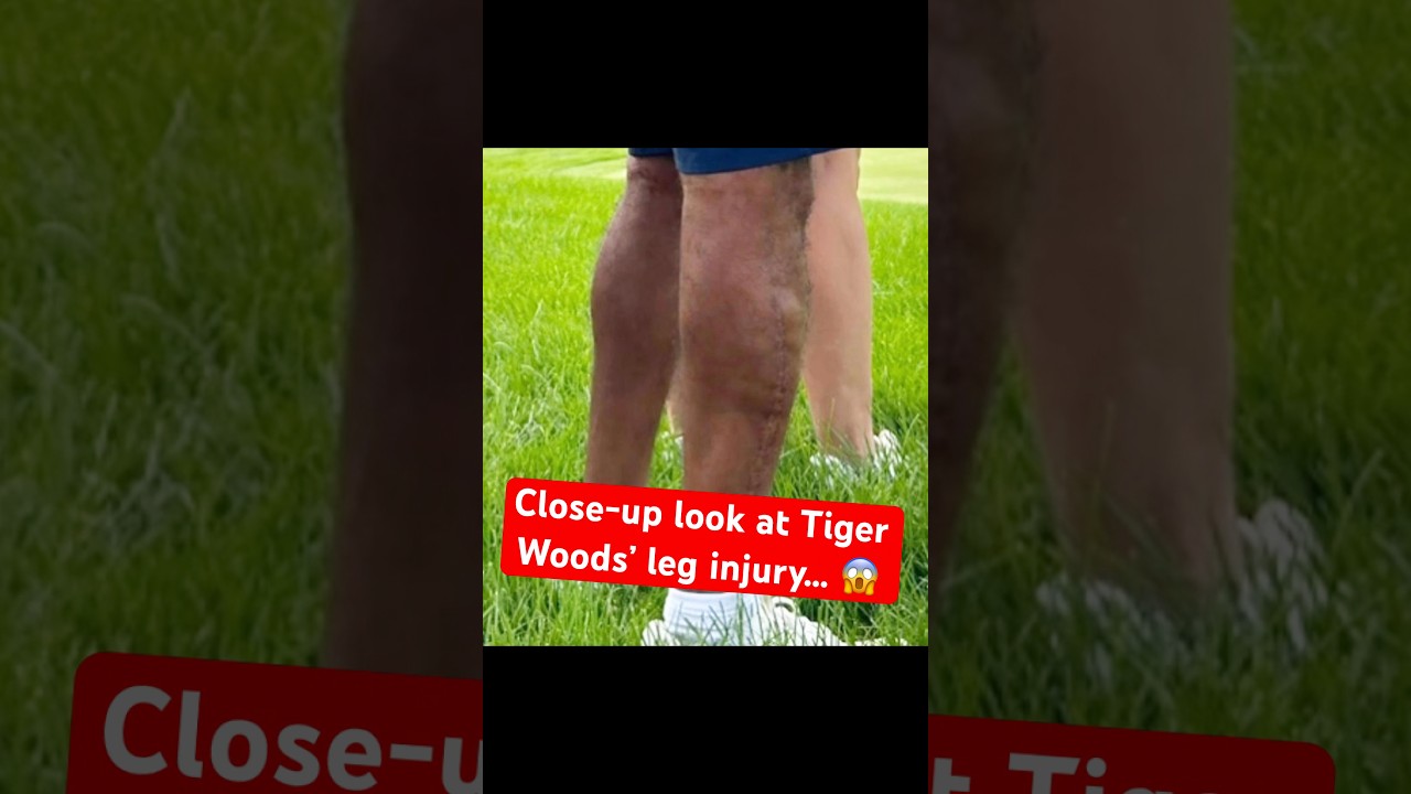 BREAKING: You won’t believe this footage of Tiger Woods’ leg injury… 😱 #golf #tigerwoods